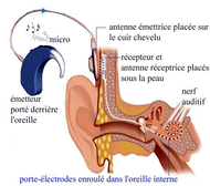 implant cochléaire